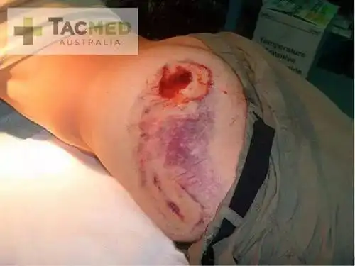 军医:宁愿被ak47打 也不想挨m4一枪