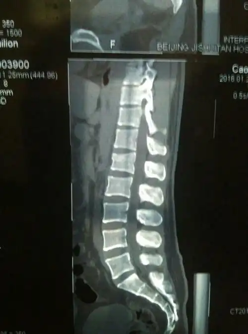 诊断是第一第二节腰椎压缩性骨折!请问得卧床多长时间?