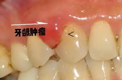 牙龈瘤微创摘除3例