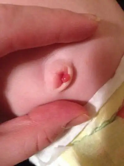 宝宝脐疝图片 (25)