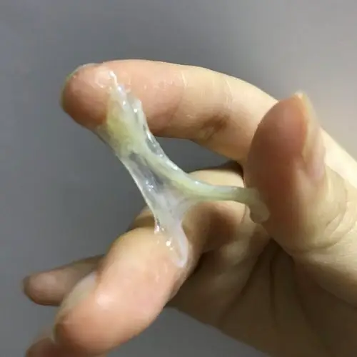 霉菌用药中 有人白带呈胶水状吗(慎入)