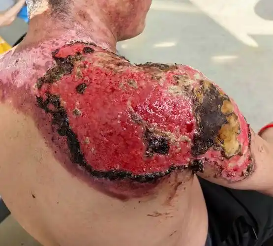 癫痫患者肩部深度烧伤一例