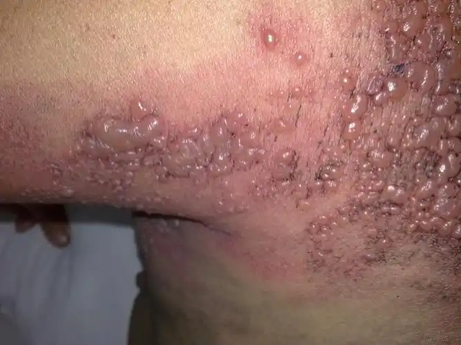 艾滋病皮疹特点_艾滋病症状_艾滋病咨询检测网