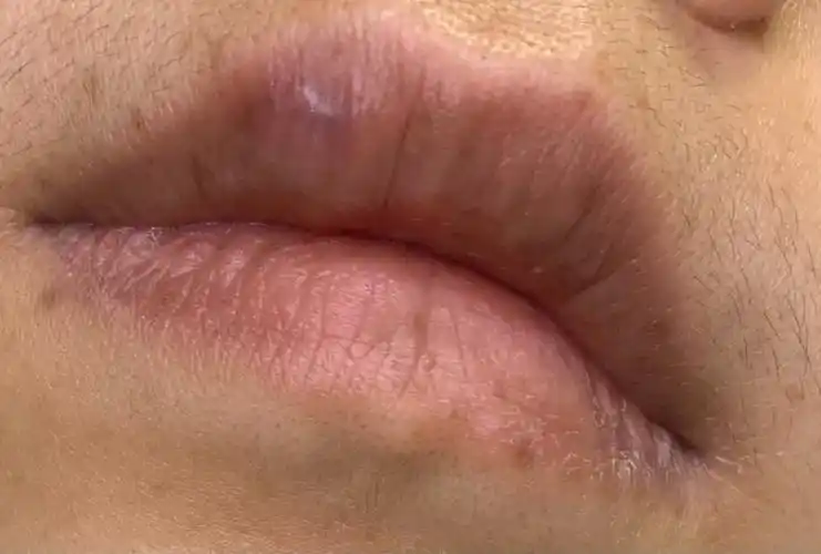 嘴唇摔伤快二个月,这疤痕能消吗?