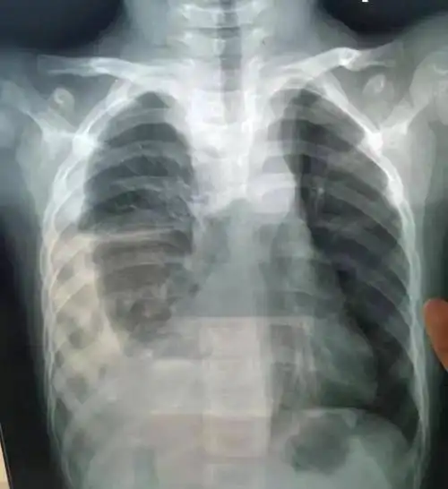 四岁孩子被水淹掉的右肺