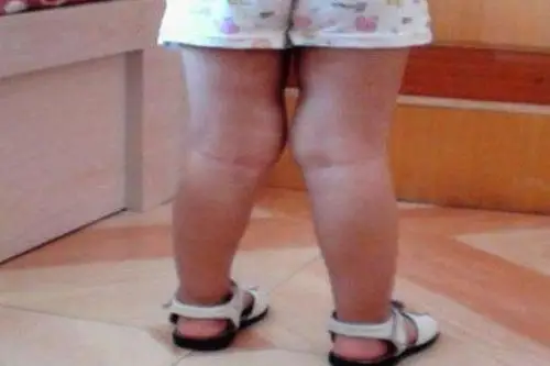 宝宝腿型有问题?父母是否注意到呢!