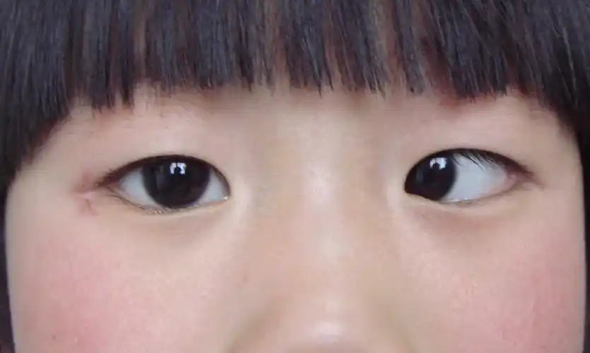 斜视和弱视科