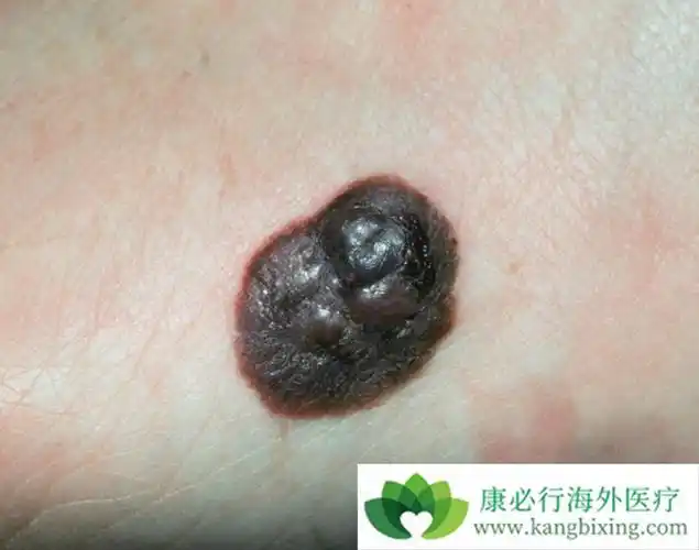 达拉非尼联合曲美替尼治疗黑色素瘤的效果如何?