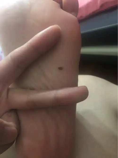 脚底板痣