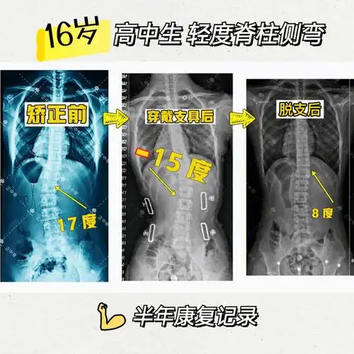 高中生脊柱侧弯0599半年康复过程记录