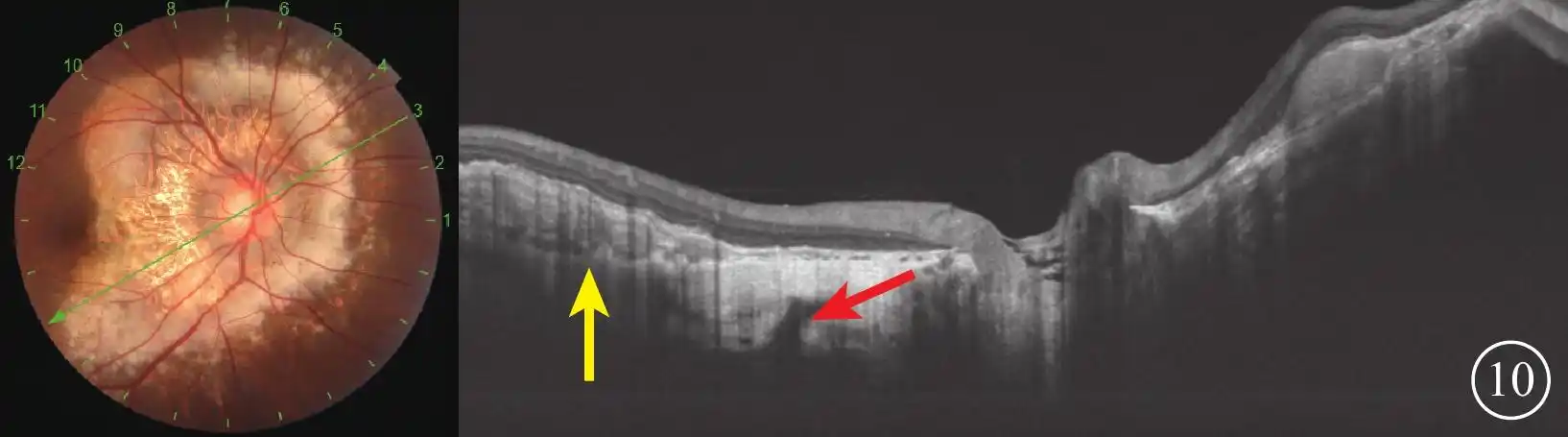 脉络膜骨瘤扫频源光相干断层扫描影像特征