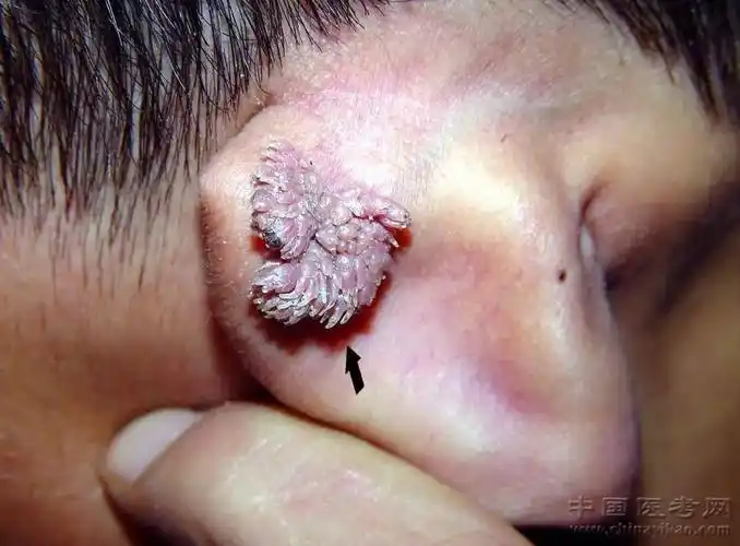 密集恐惧症及非医护人员慎点!史上最全的皮肤病图谱来了(修订版)!