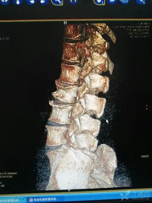 l2压缩性骨折求助 [病例帖]