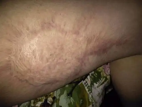 河北省中医院植皮手术后疤痕如何修复