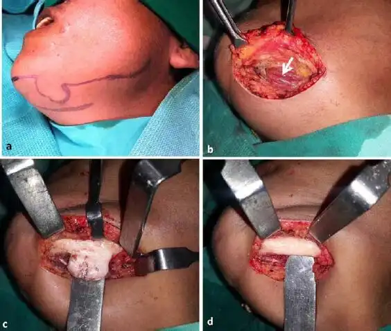 【病案】存在吞咽困难的单发性下颌骨骨肉瘤