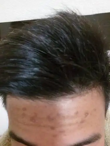 17岁学生额头上有痘痘,还有的抠破了,颜色较深,能消除吗?