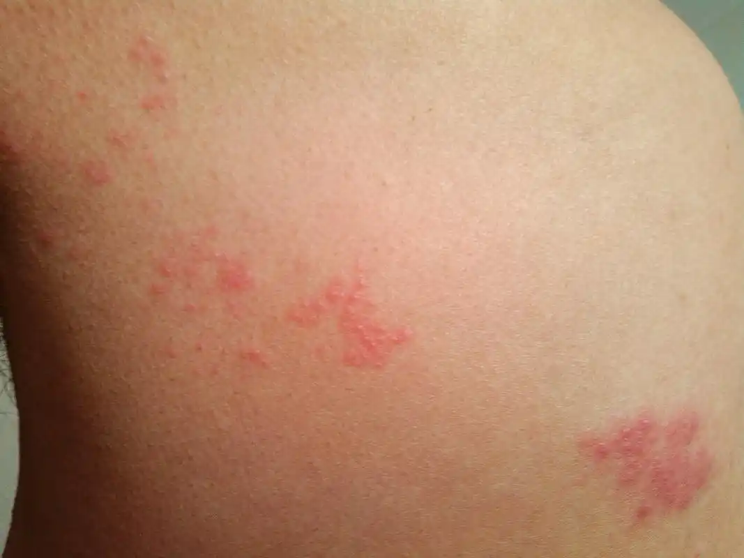过敏了,先是胸部酸痛,触摸有刺痛感,皮肤表面无异样,一天后出现红疹