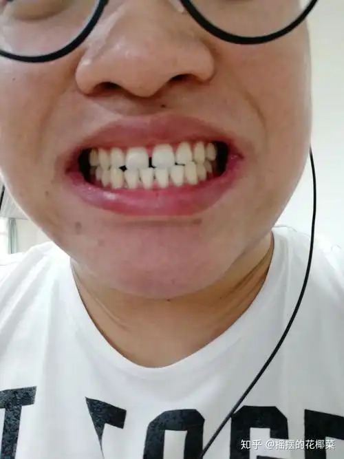 2019年9月11日,带牙套时一般使用电动牙刷和水牙线清洁牙齿,拆除牙套