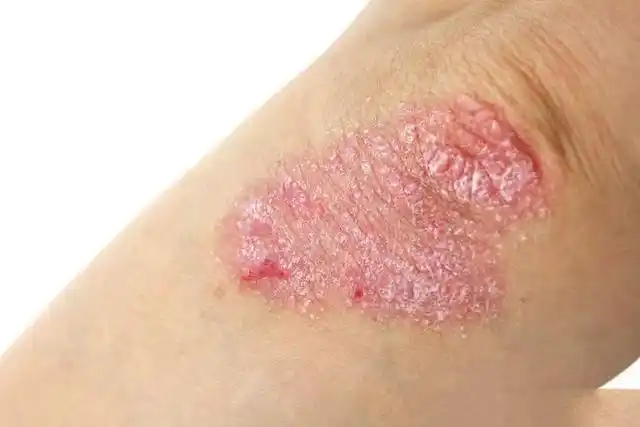 皮肤病图片对照大全查看图片