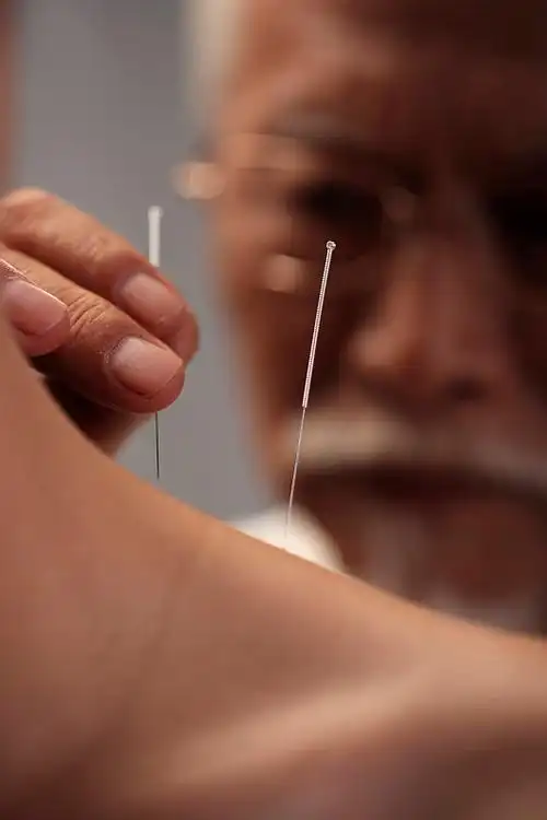 中医针灸