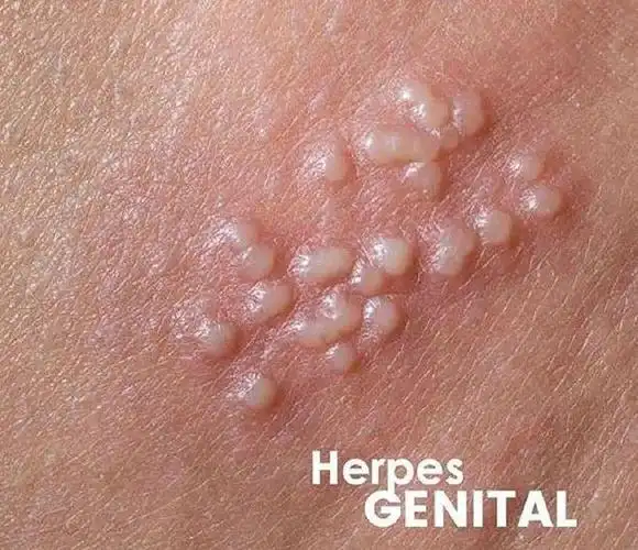 急性化脓扁桃体 艾滋_艾滋病急性期_乙肝和艾滋那个病可怕