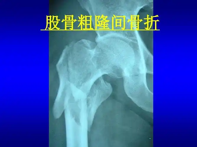 你可能喜欢 股骨骨折术后康复 股骨骨折临床路径 肱骨髁间骨折 股骨髁