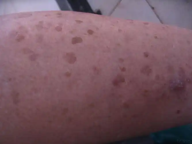 四肢皮肤色斑如图,请诊断?