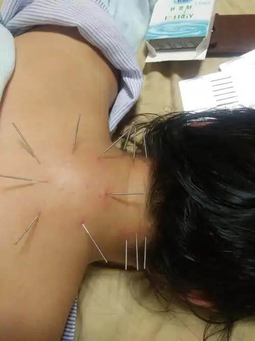 贵州毕节有中医针灸艾炙培训的学校想学针灸理疗的谭老师可以介绍