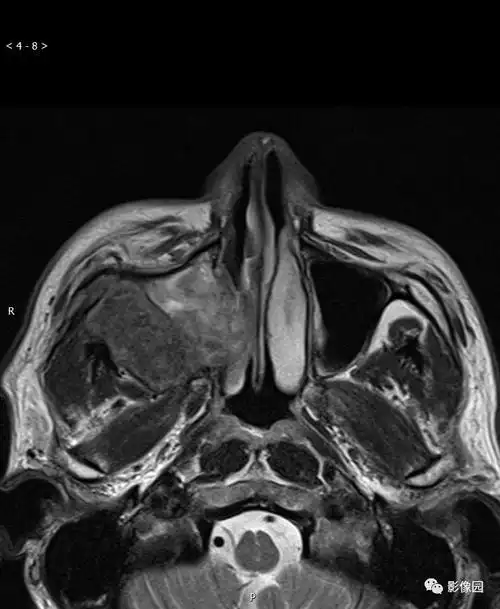 典型右侧上颌窦癌1例