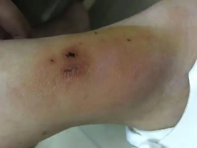 左脚踝部红肿疼痛2天原