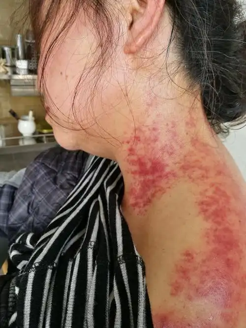 开刮,一会儿颈椎右侧,脖子两边痧痕累累,全是结节.