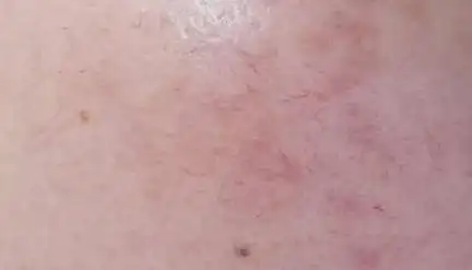 自身形成红血丝的日常护理方法