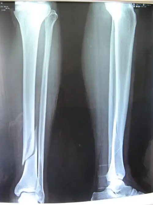 左胫骨下1/3闭合性骨折病例