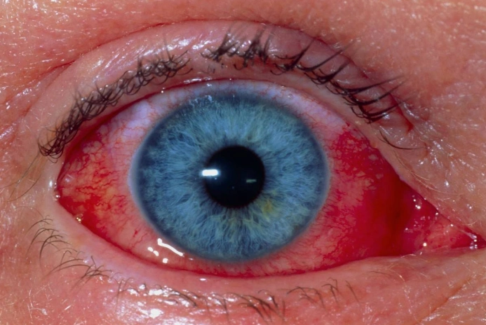 眼睛流血图片 (2)_有来医生