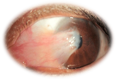 注意啦,如果眼睛上长了这种"小息肉",赶紧找医生看看