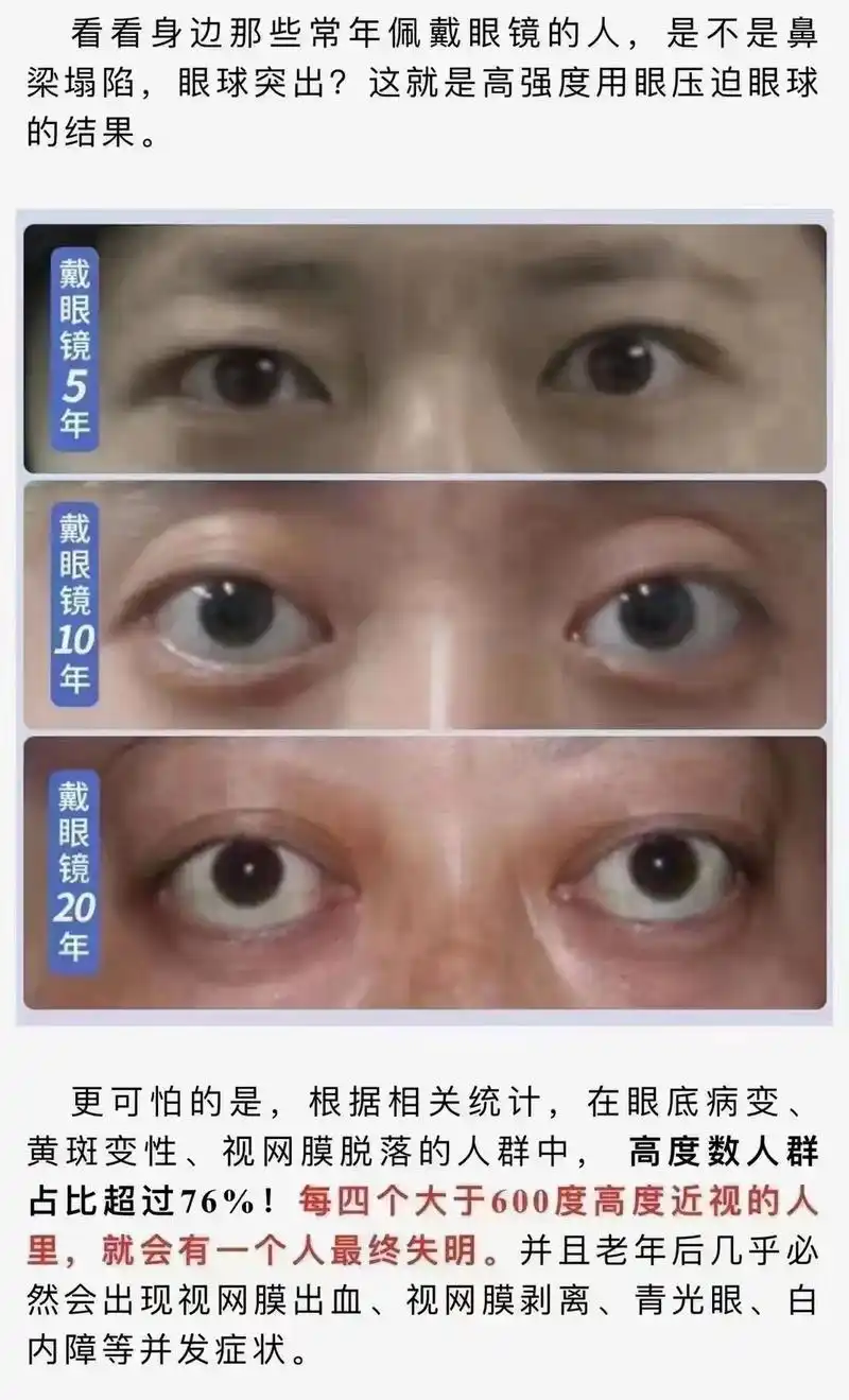 眼睛度数上涨原因之一(镜框变形)|||眼镜变形一定要及时拿到眼镜店