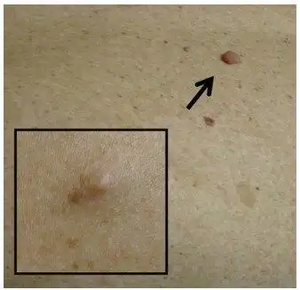 儿童i型神经纤维瘤病的健康监控 - 好大夫在线