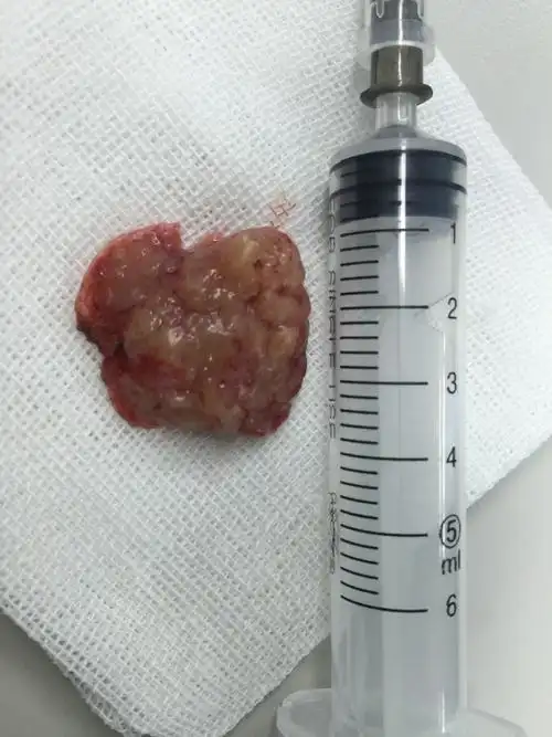 左额顶开颅脑膜瘤切除术 - 好大夫在线