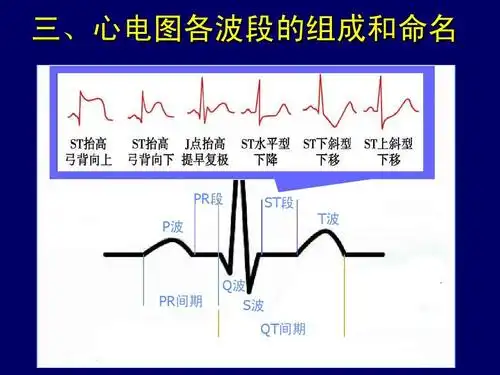 医学专业课件 三,心电图各波段的组成和命名 qrs波群 r波 pr段 p波 st