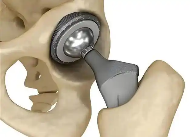 骨科医疗钛合金零件制造加工订做