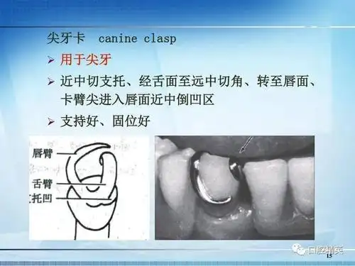 可摘局部义齿卡环的种类