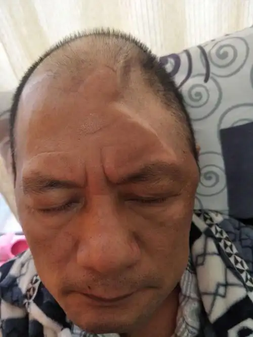 做腰椎穿刺后,头部慢慢凹陷,人越来越清醒