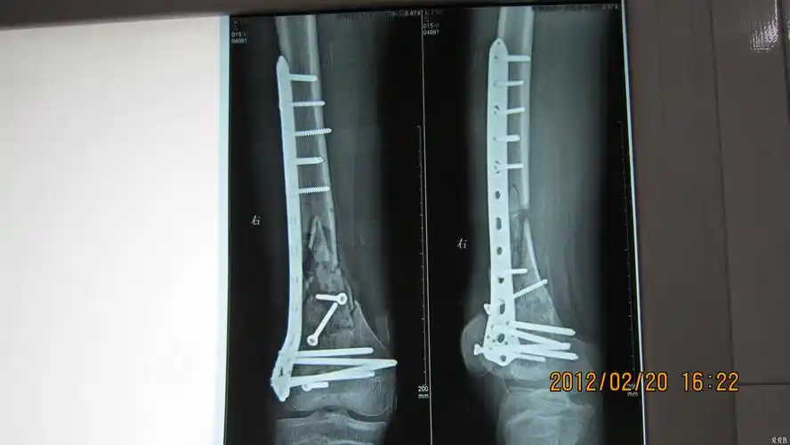 股骨髁上骨折70余天