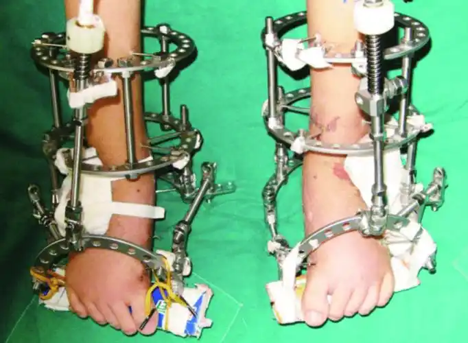 断骨增高丨花16万断骨只为长高72厘米如今李亚诺艰难的康复之路