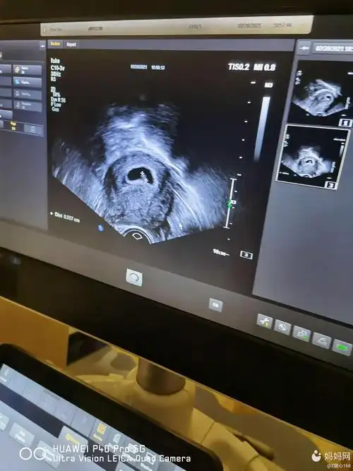 孕囊是茄子形状的让保胎看效果09