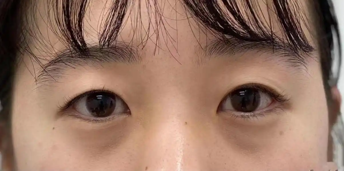 上睑皮肤松弛的单眼皮,老里老气,没想到做完双眼皮这么显年轻!