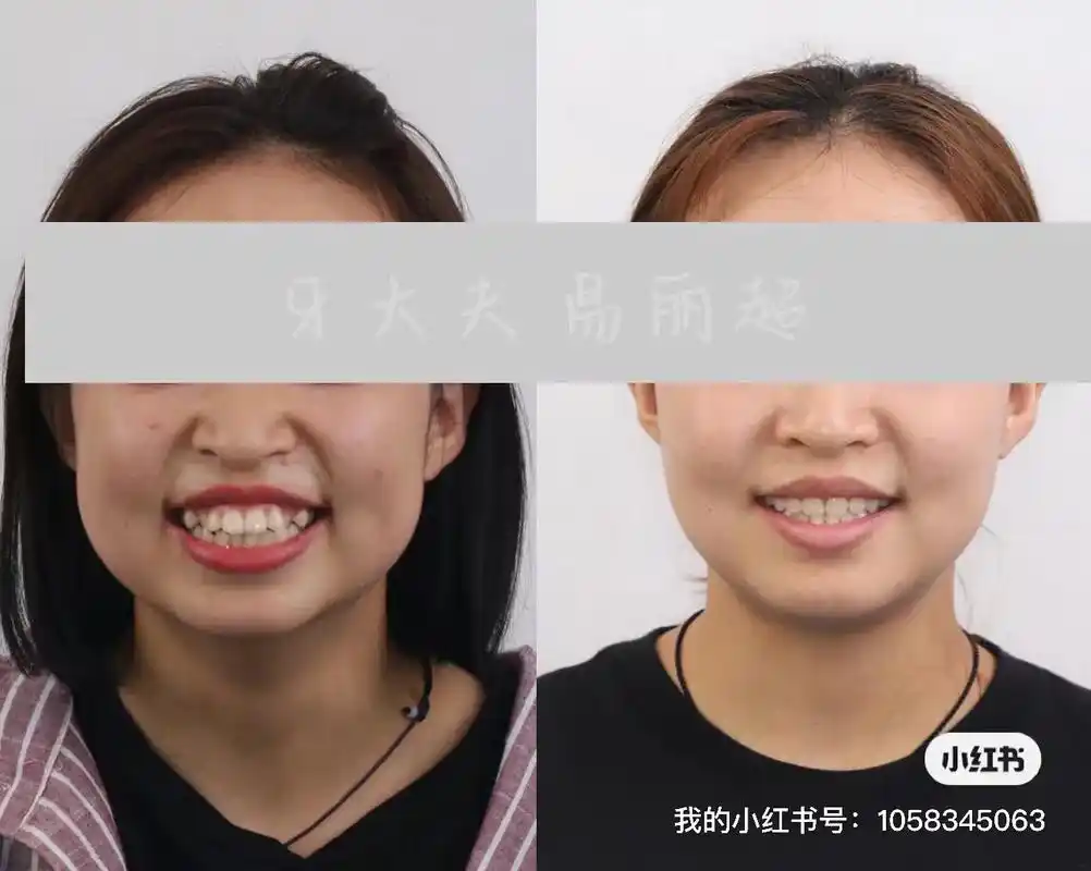 患者主诉牙齿前突,拔除4颗正畸牙,通过 牙内收 - 抖音