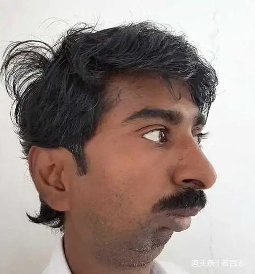 男子磕到下巴38年张不了嘴,手术打开4.5厘米告别天天吃流食