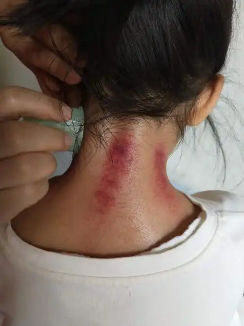 推荐两种刮痧手法,蜜芽罐操作简单易行,刮痧板也可以. 1.