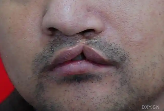 【讨论】大伙看看这个唇裂二期怎么整 [病例帖]